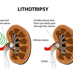 Kidney Stone Surgery in Bhubaneswar: Expert Care by UNCE (Uro Nephro Center of Excellence)
